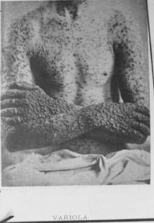variole